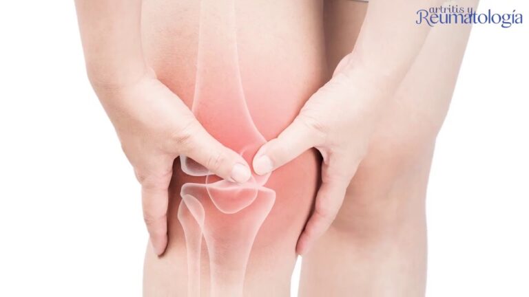Tratamiento Natural Eficaz para la Artritis